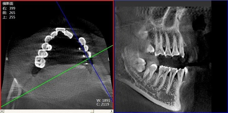 Panoramic Imaging Digital CBCT Dental System