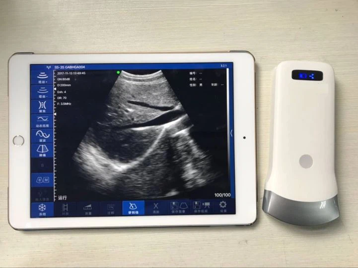 wireless ultrasound